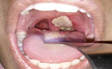 Tension Breaks Out In Abia After Diphtheria Hits Nearby Imo