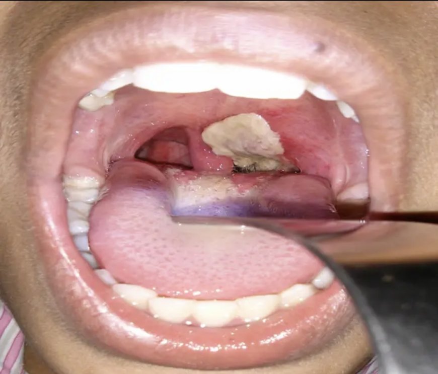 Tension Breaks Out In Abia After Diphtheria Hits Nearby Imo